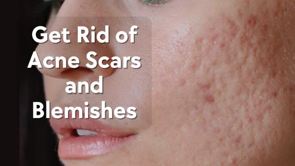 Get Rid of Acne Scars and Blemishes