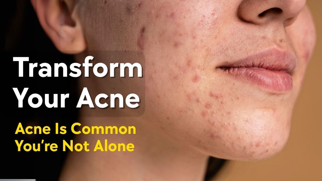 Transform Your Acne